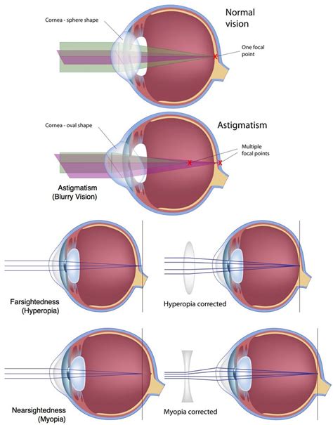 LASIK Eye Surgery for Vision Correction at Fort Worth Eye Associates