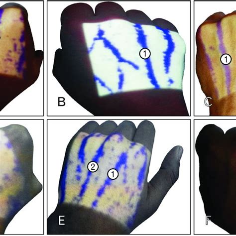 (A) Left hand showing prominent dorsal metacarpal vein (1) in the ...