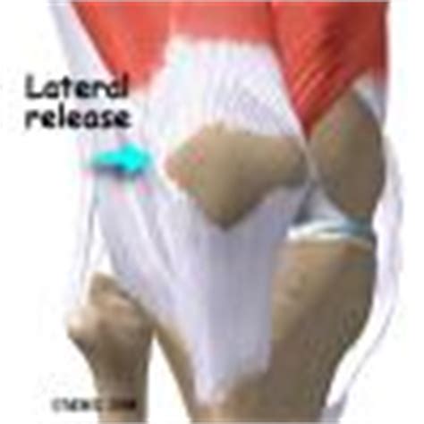 Chondromalacia Patella | eOrthopod.com