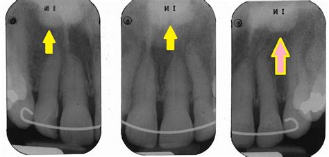 Palatal Tori – Dr. G's Toothpix