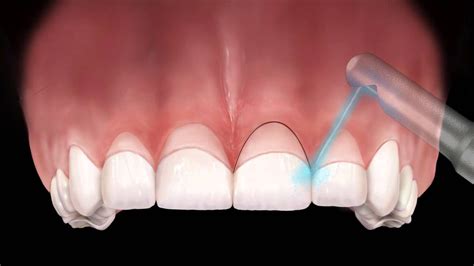 Gingivectomy and Gingivoplasty : Gingivectomy is the removal of gum ...