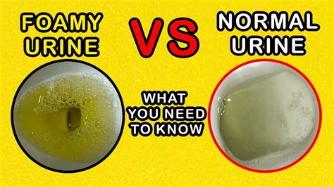 Foamy Urine vs Normal Urine: What is the difference and causes - YouTube