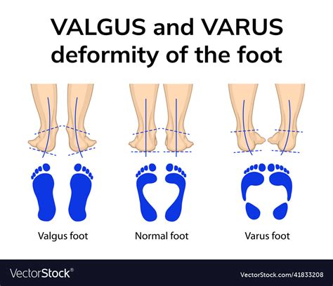 Varus and valgus deformity of the foot Royalty Free Vector