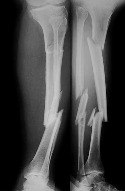 Best Broken Leg Xray Stock Photos, Pictures & Royalty-Free Images - iStock