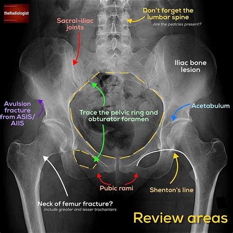 👨🏽‍💻Want to learn a system for reviewing a pelvic X-ray? Read on to ...