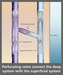 Perforating Vein Treatment CT | Varicose Veins & Ulcers | Vein Centers CT