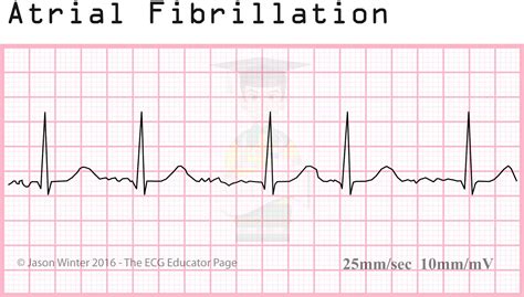 Atrial Fibrillation Ecg Interpretation | Hot Sex Picture