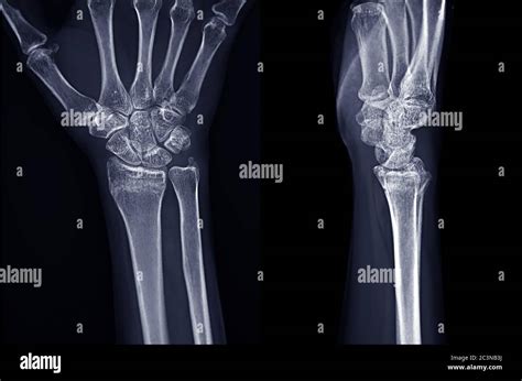 X-ray image of Right wrist joint Ap and Lateral view for diagnosis ...