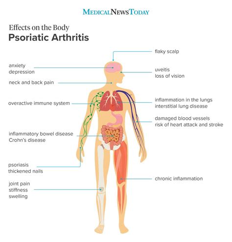 8 effects of psoriatic arthritis on the body