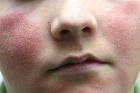 Skin rashes in children - NHS.UK