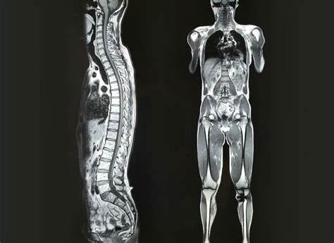 Whole-body MRI for Identifying Metastatic Disease in Colorectal Cancer ...