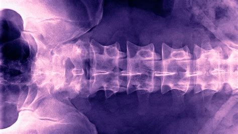 Compression fracture treatments: Options and recovery