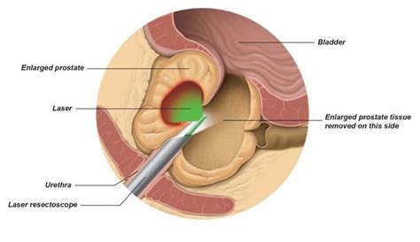 Green Light Prostate Surgery Complications | Shelly Lighting