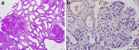 | Light microscopy findings in kidney light chain deposition disease ...