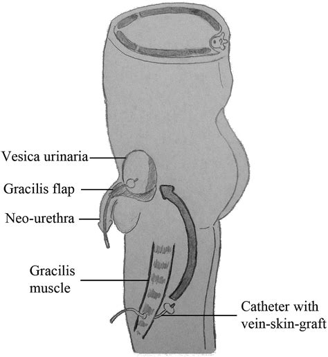 Plastic reconstructive surgery techniques using VRAM or gracilis flaps ...