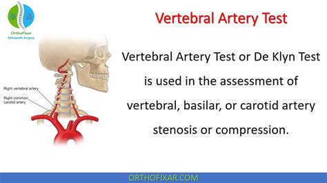 Vertebral Artery Test | OrthoFixar 2024