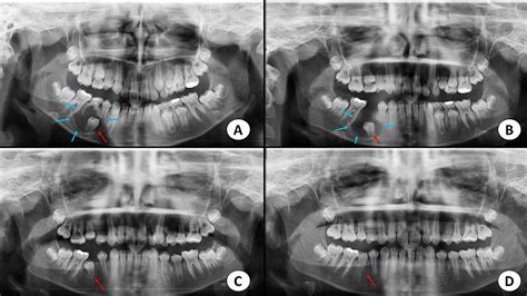 Spontaneous Eruption of a Deeply Impacted Premolar After Conservative ...