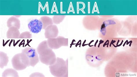 Plasmodium Falciparum Under Microscope