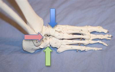 What is triple arthrodesis? - Orthopedic Specialists of Seattle