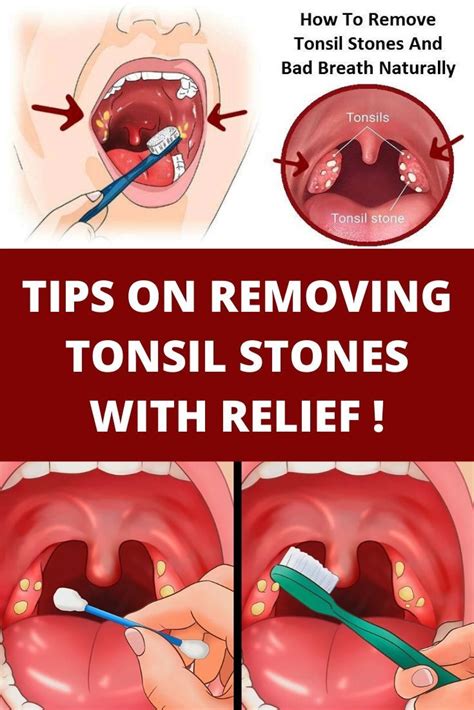 White Spots On Tonsils Treatment