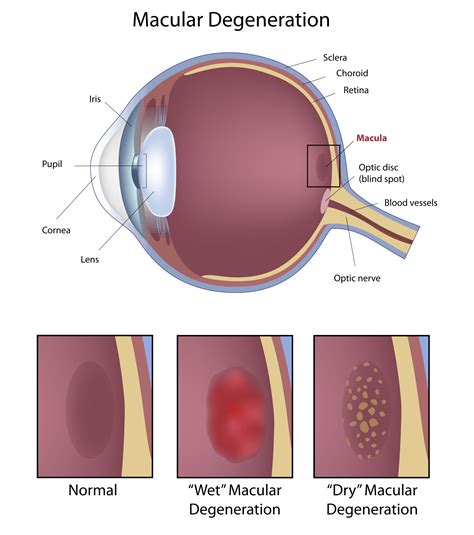 Macular Degeneration | Petrou Eye Care