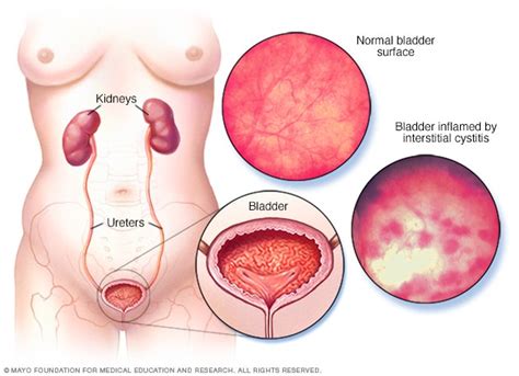 Interstitial cystitis - Symptoms and causes - Mayo Clinic