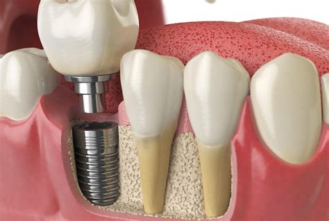 Dental Implant: How it Works & What to Expect