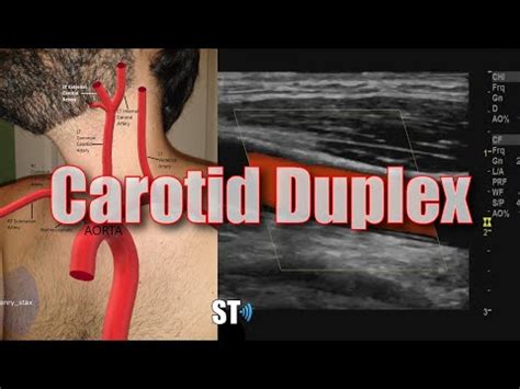 Listen And Download - Carotid Duplex/Doppler Protocol