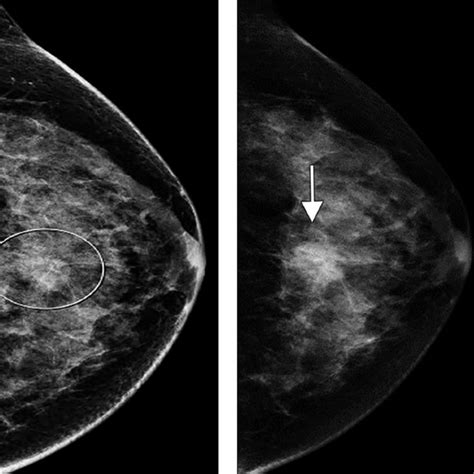 Contrast-Enhanced Mammography: Current Applications and Future ...