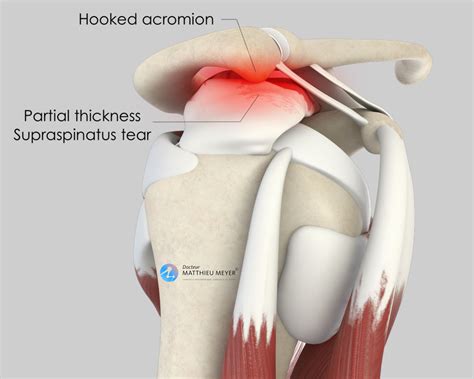 Arthroscopic Shoulder Acromioplasty - Doctor Matthieu Meyer