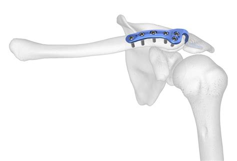 EL-Clavicle-Plating-System-Hook-Plate-on-bone | Acumed