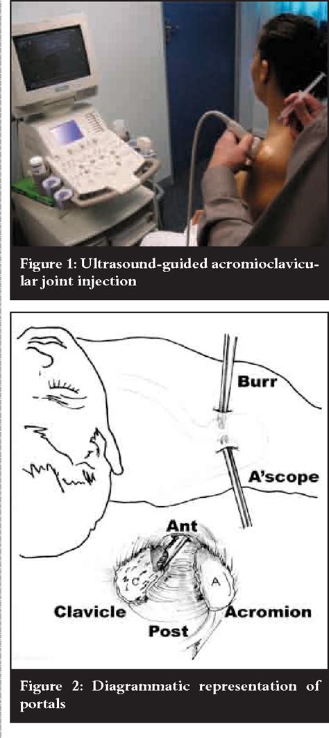 Figure 1 from Acromioclavicular joint: Direct arthroscopy, the Mumford ...