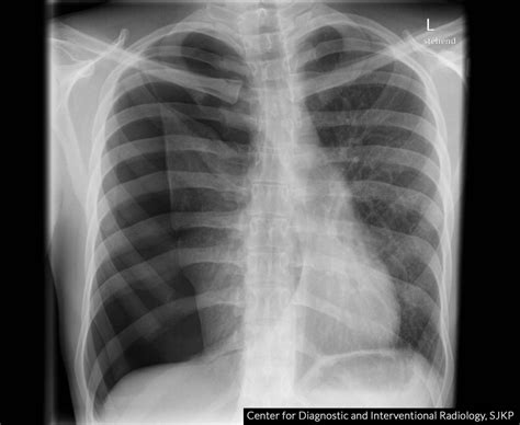 Tension Pneumothorax: What Is It, Causes, Signs, Symptoms,, 49% OFF