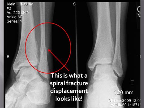 Fracture Fibula