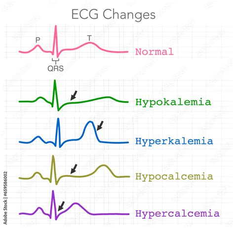 ECG changes. Hypokalemia, Hyperkalemia, Hypercalcemia, Hypocalcemia ...