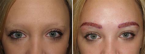 Eyebrow Transplantation Photos | Miami, FL | New York, NY | Patient 16487