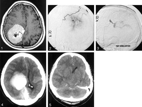 Fig 1. | Postembolization Hemorrhage of a Large and Necrotic Meningioma ...