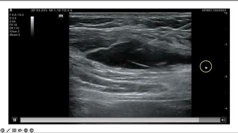 Ultrasound Guided Serratus Anterior Block - YouTube