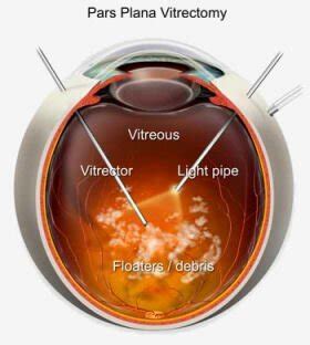 Vitrectomy