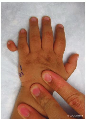 Postaxial Polydactyly | Musculoskeletal Key