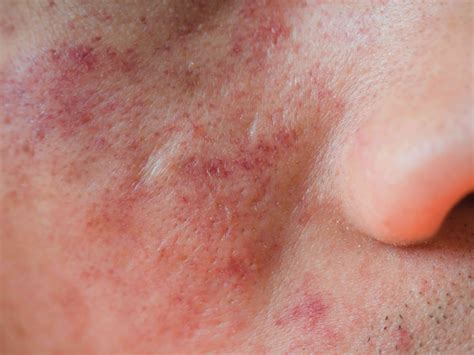 Eczema on the Face: Symptoms, Causes, Diagnosis, Treatment