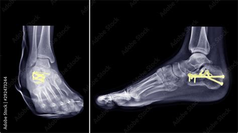 Film ankle X-ray radiograph showing heel bone broken (Calcaneus ...