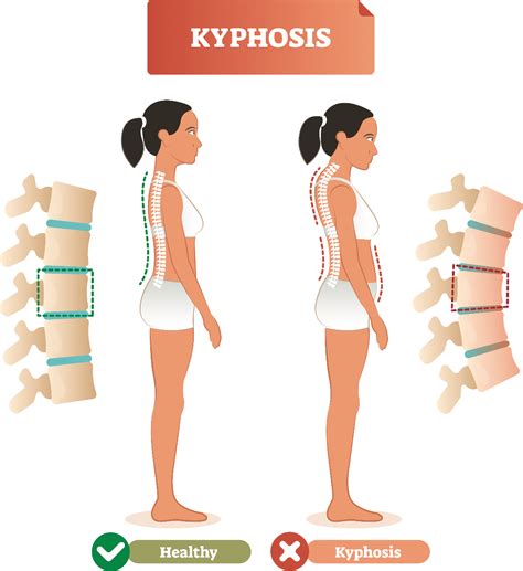 Postural Kyphosis Correction