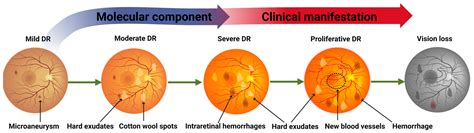 IJMS | Free Full-Text | Towards a New Biomarker for Diabetic ...