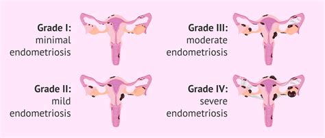 What are the degrees of endometriosis?