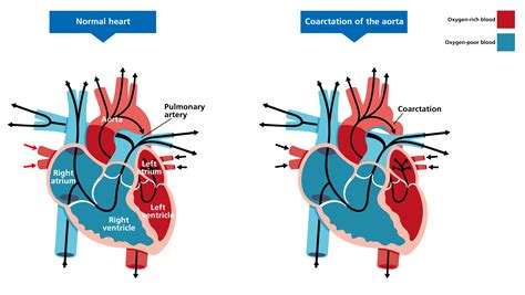 Coarctation of the aorta — Knowledge Hub