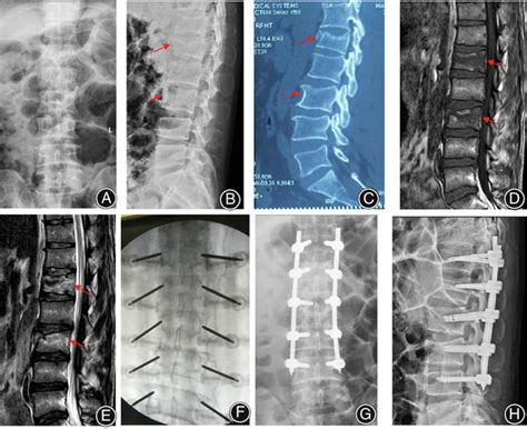 Patient 1, female, 40 years old, suffered from L1 and L3 fractures due ...