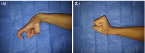 Figure 1 from Entrapment of the extensor indicis proprius tendon in the ...