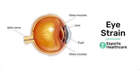 How To Get Rid Of Eye Strain - Artistrestaurant2