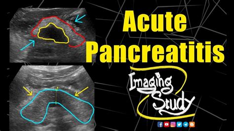 Acute Pancreatitis || Ultrasound || CT || Case 206 - YouTube